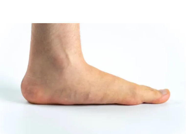 Плоскостъпието pes planus